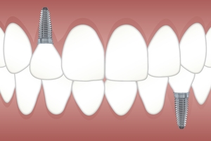 Вижте каталога ни с Dental Implants 34