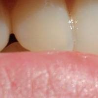 Каталог зъбни протези 11