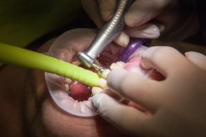 Top Dental Implants 21