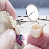 поставяне на зъбни импланти - 75326 клиенти