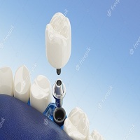 поставяне на зъбни импланти - 88868 типа