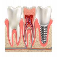 поставяне на зъбни импланти - 79267 предложения