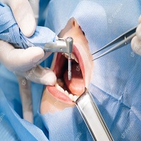 поставяне на зъбни импланти - 73321 комбинации