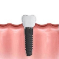 поставяне на зъбни импланти - 29566 разновидности