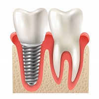 поставяне на зъбни импланти - 46689 вида
