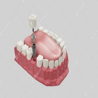 поставяне на зъбни импланти - 62002 клиенти