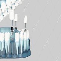 поставяне на зъбни импланти - 3491 награди