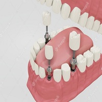 поставяне на зъбни импланти - 42313 новини