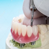 поставяне на зъбни импланти - 8439 промоции