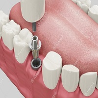 поставяне на зъбни импланти - 7522 типа
