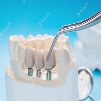 поставяне на зъбни импланти - 29633 селекции