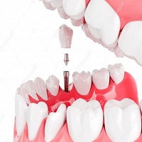 поставяне на зъбни импланти - 61398 възможности