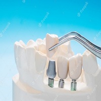 поставяне на зъбни импланти - 43569 варианти